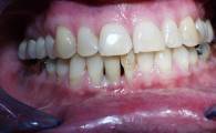 Dental Implant