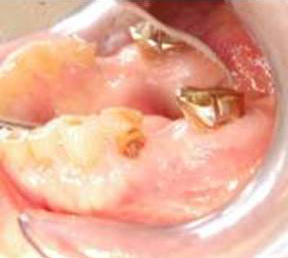 Dental Implant