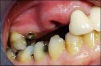 Dental Implant