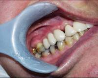 Dental Implant