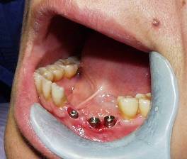 Dental Implant