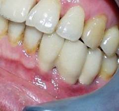 Dental Implant