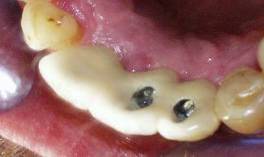 Dental Implant