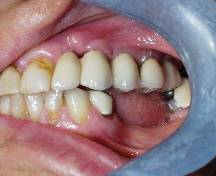 Dental Implant